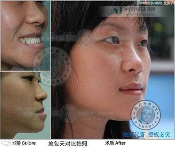 牙齿地包天怎么矫正 地包天怎么拍照好看？