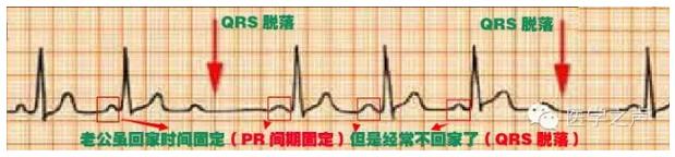 十二导联心电图详解 心电图详解