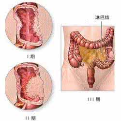 慢性结肠炎用药 慢性结肠炎的症状