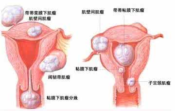 子宫肌瘤如何调理 子宫肌瘤如何调理 【魅力女人】哪些女性容易患子宫肌瘤