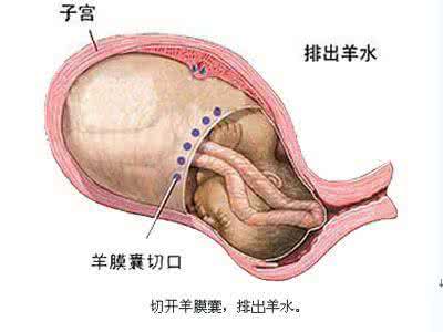 剖腹产横切还是竖切好 剖腹产横切二胎怎么切 剖腹产是选择横切还是竖切，原来有这么大的学问