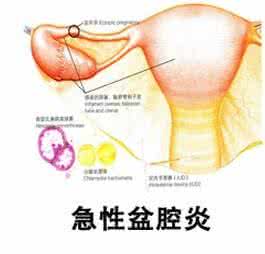 盆腔炎的最佳治疗方法 盆腔炎 盆腔炎的治疗