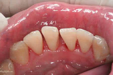 如何治疗牙周炎 牙周炎治疗 如何正确治疗牙周炎