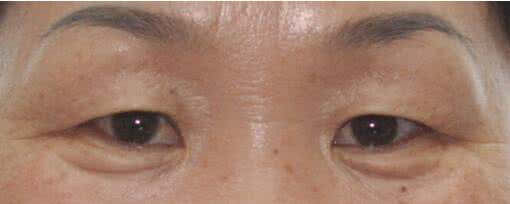 眼睑整形手术 眼睑整形手术 下眼睑整形用到的手术材料和设备