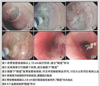 沪深300最小变动价位 沪上治愈世界最小年龄贲门失弛缓症