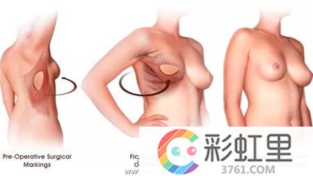 防治乳房湿疹样癌 女人什么样的乳房要查癌