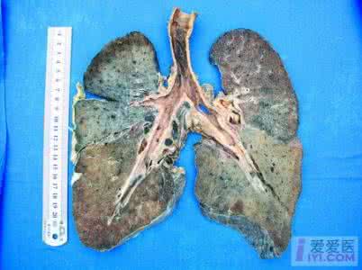 陶工尘肺 陶工尘肺要怎么保重身体