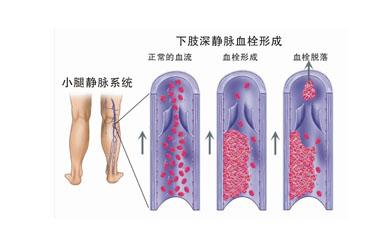 深静脉血栓形成原因 深静脉血栓形成 它有哪些发病原因