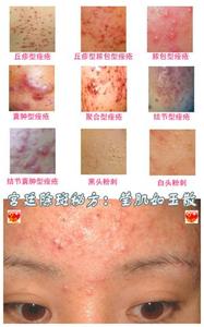 莹肌如玉散 宫廷除斑秘方:莹肌如玉散