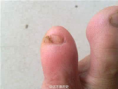 乳头分成两瓣正常吗 乳头分成两瓣正常吗 乳头天生是两瓣的原因？