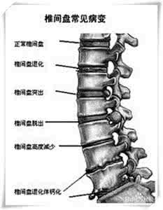 螺丝钉螺丝帽 打螺钉治椎间盘突出4年后螺帽脱落