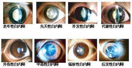 先天性白内障症状 先天性白内障症状 5个方法帮你治疗白内障
