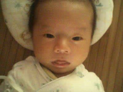 新生儿黄疸眼睛图片 新生儿黄疸有哪些症状