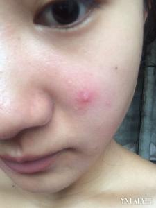 一天之内消除痘痘红肿 痘痘 痘痘红肿