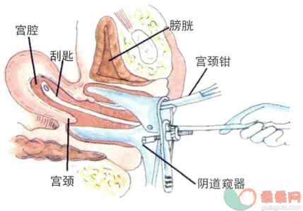 刮宫疼不疼 刮宫疼不疼呢