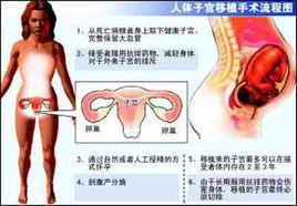 摘除子宫有什么影响 人子宫移植 生育后摘除子宫是更好的选择