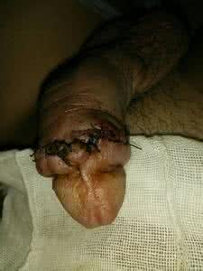 小孩包皮手术后水肿是什么原因