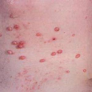 疥疮长在龟头上怎么办 扁皮尤 长疥疮了怎么办？