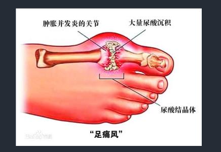 痛风发作怎么缓解疼痛 痛风怎么缓解疼痛 痛风可以这么做
