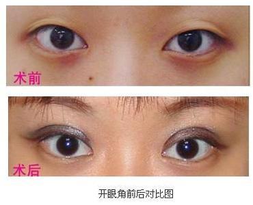 什么叫开眼角 开眼角 什么叫开眼角?