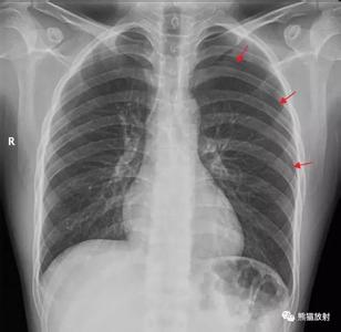 气胸最好的治疗方法 气胸严重吗 治疗气胸的方法有哪些