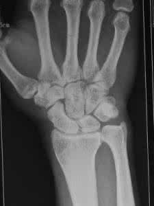 正确处理中暑的方法 脱臼的处理 正确处理脱臼的方法是什么