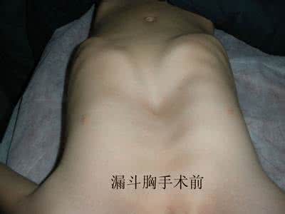 先天性漏斗胸 漏斗胸怎么治疗好 先天性漏斗胸怎么治疗