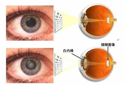 白内障的治疗方法 白内障治疗方法 三大方法有效治疗白内障