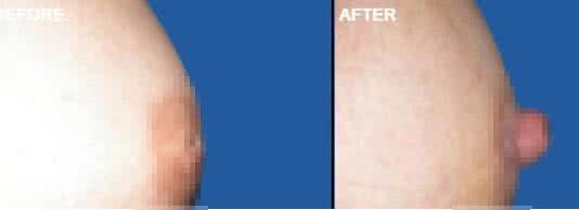 产妇乳头凹陷怎么喂奶 产妇乳头凹陷怎么喂奶 乳头内陷喂奶无压力 写给乳头内陷的妈妈们