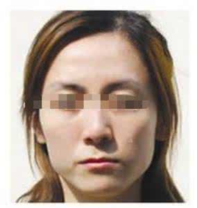 中风面瘫嘴歪怎么治疗 嘴歪自己怎么治疗？