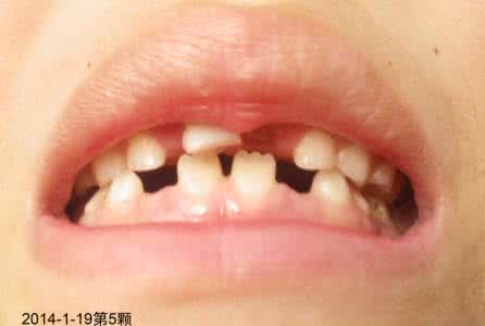 乳牙换牙顺序 小孩什么时候换牙最好 小孩什么时候换乳牙