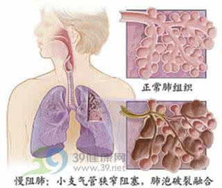 慢性阻塞性肺疾病 老年慢性阻塞性肺疾病继发肺真菌病危险因素的临床研究