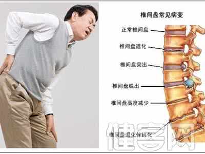 腰椎间盘好发部位 腰椎间盘突出症的康复