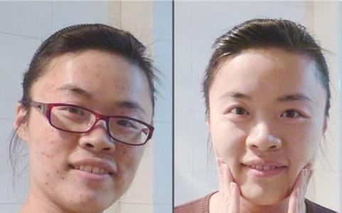 激光去痘和痘印好吗 激光痘印 激光祛痘印