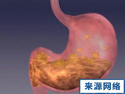 胃溃疡糜烂会癌变吗 胃溃疡会癌变吗 这处溃疡超过15天小心癌变