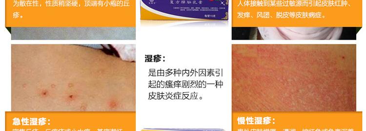 荨麻疹皮肤瘙痒 皮肤瘙痒荨麻疹 动不动荨麻疹、湿疹瘙痒？甚至染梅毒！就用这个土药！