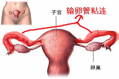 输卵管积水治疗价格 该如何治疗输卵管积水粘连