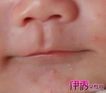 寻麻疹快速止痒偏方 疾病预防 寻麻疹偏方 寻麻疹的症状