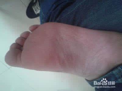 白醋能治脚气 白醋能治好重度脚气吗？