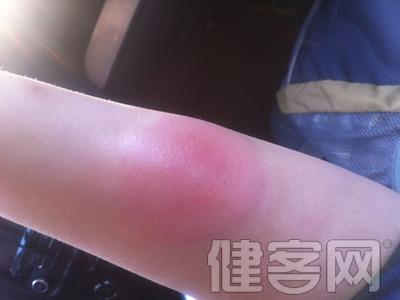 慢性荨麻疹如何预防 慢性荨麻疹 如何预防慢性荨麻疹