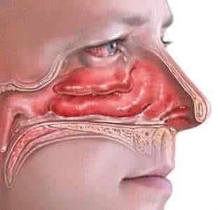 鼻窦炎的最好治疗方法 鼻   炎