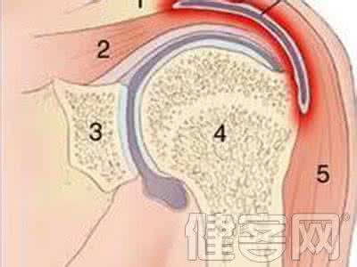 滑囊炎最佳治疗方法 滑囊炎是什么疾病