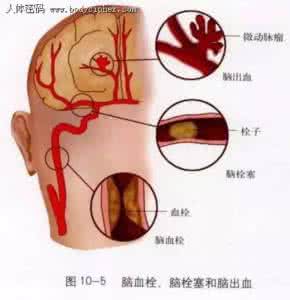 脑血栓前兆的6个表现 脑血栓前兆 当天6个暗号