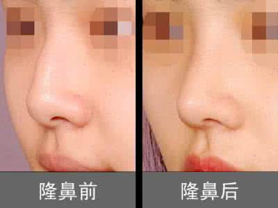 风度隆鼻贴 非手术隆鼻 风度隆鼻贴