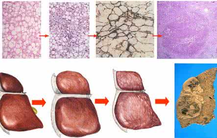 肝硬化的早期症状 肝硬化的症状 常见的肝硬化症状