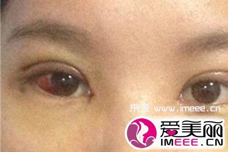 眼肌无力症状 眼肌无力都有哪些症状