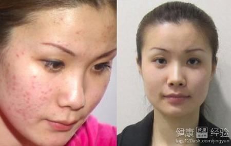 如何消除青春痘疤痕 美容护肤 青春痘疤痕怎么消除 多种方法祛青春痘疤痕