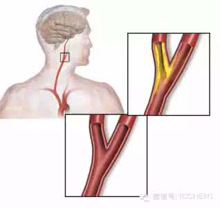 世界卒中日 10月29日世界卒中日 10月29日是什么日子？世界卒中日是几月几日