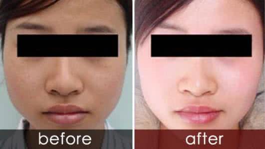 冷光子嫩肤 冷光子嫩肤 你知道怎么做冷光子嫩肤