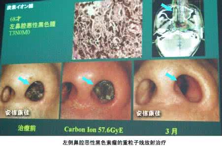 鼻腔溃疡的治疗方法 鼻腔溃疡 如何预防鼻腔溃疡